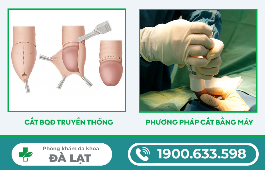 CHI PHÍ PHẪU THUẬT CẮT BAO QUY ĐẦU